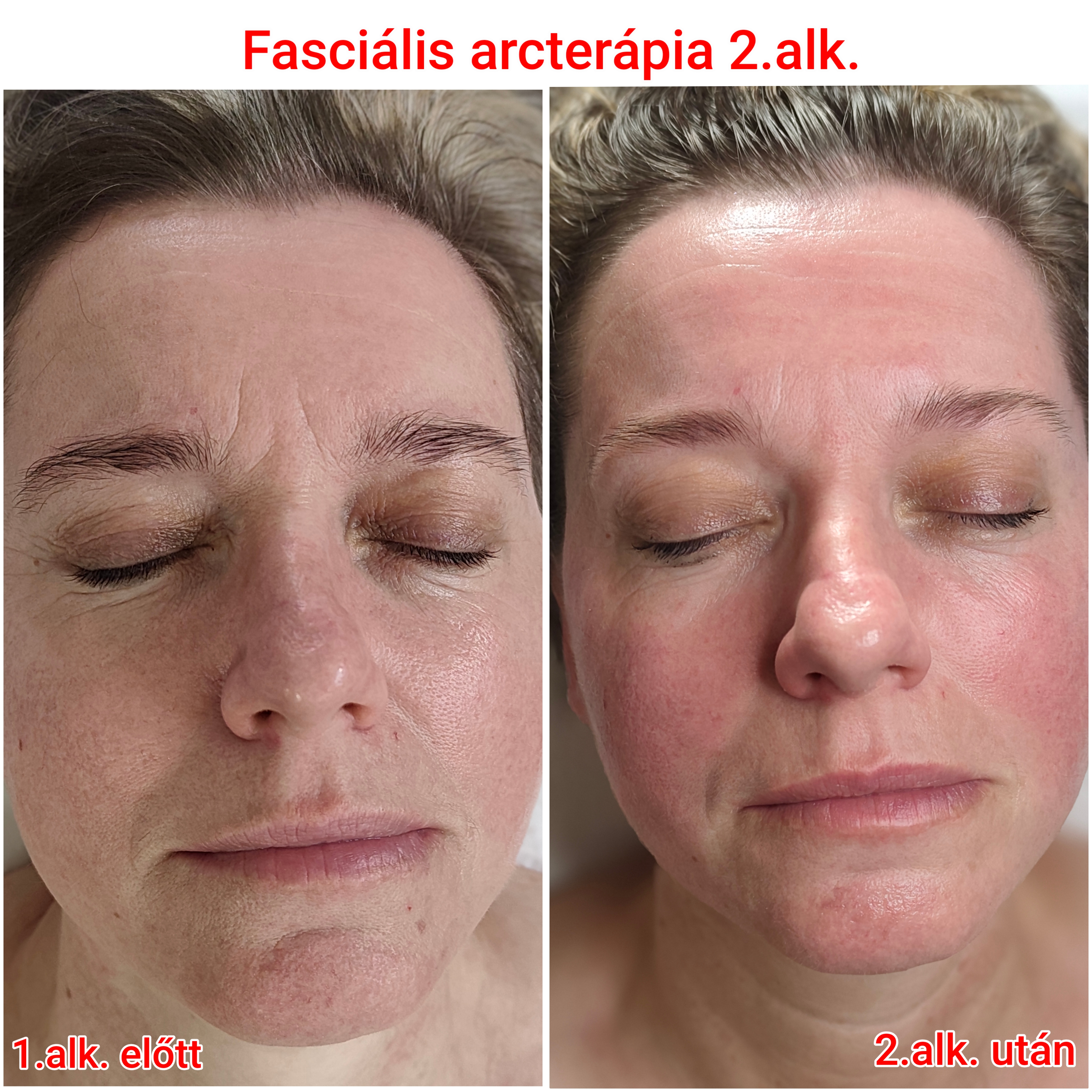 Arcterápia kezelés eredmény