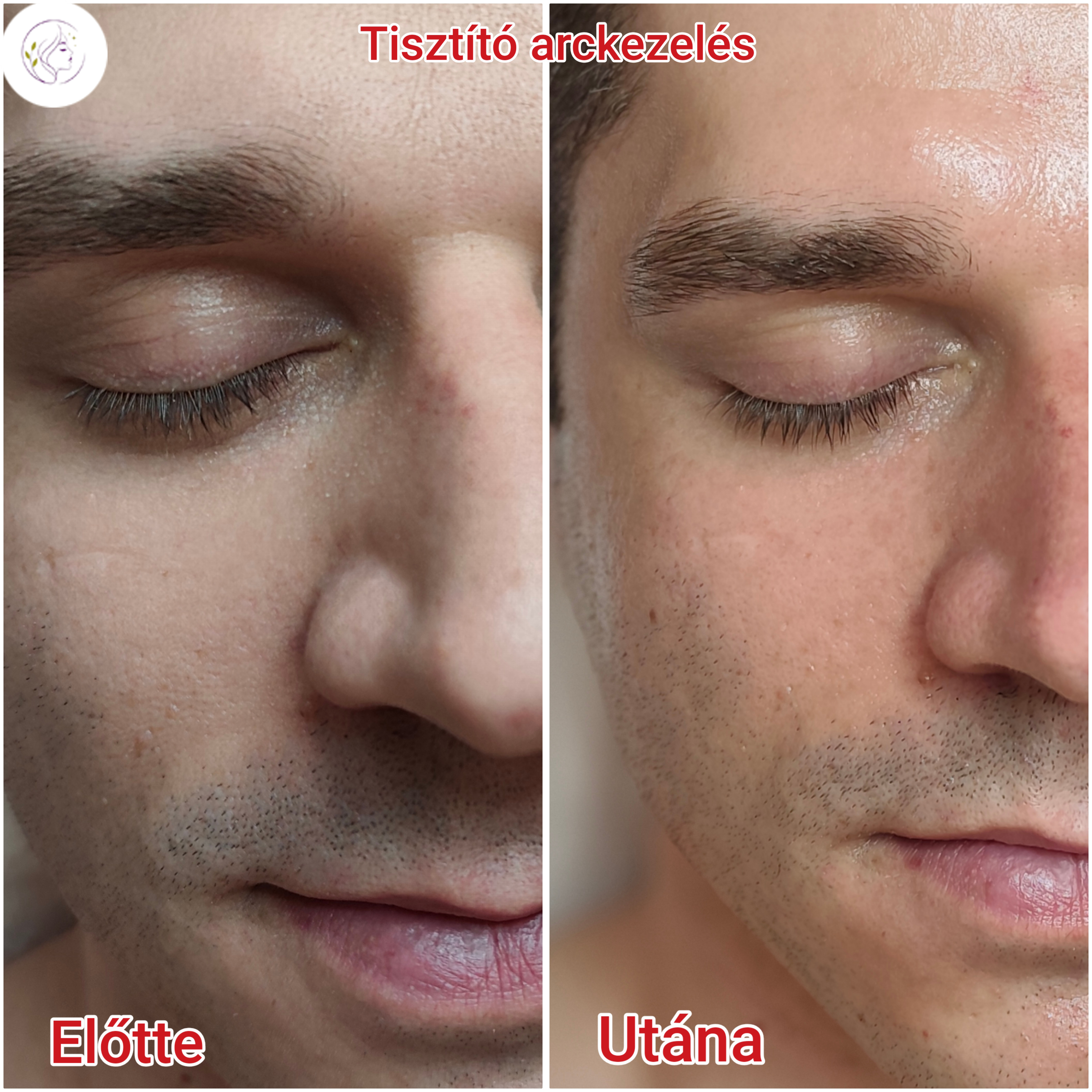 Arckezelés