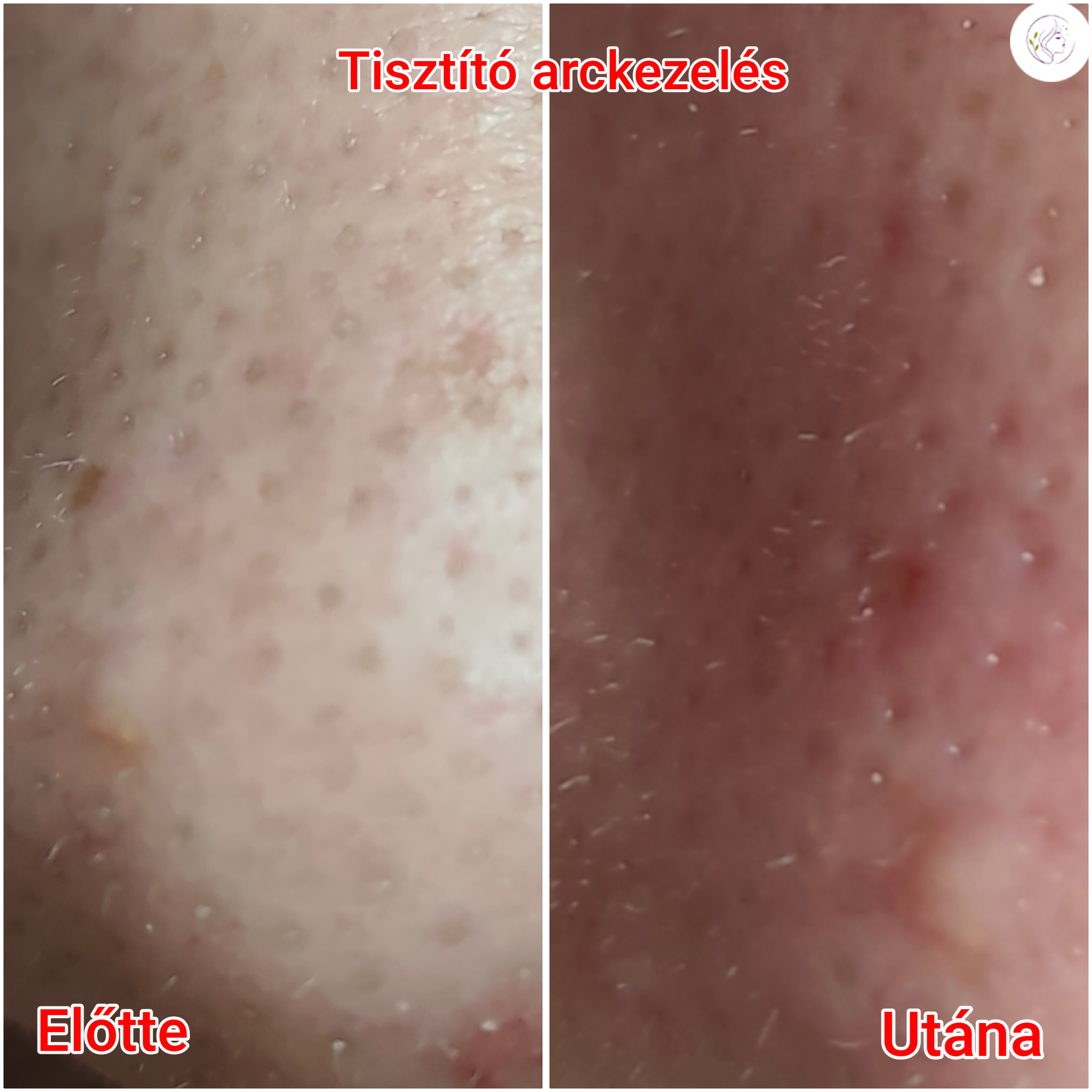 Arckezelés előtte-utána