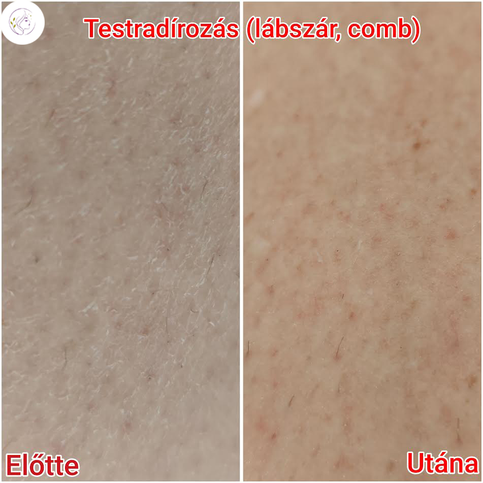 Testradírozás kezelés